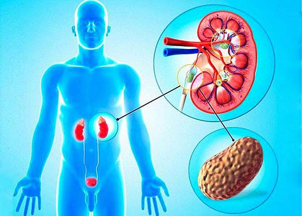 Những lưu ý quan trọng về bệnh sỏi tiết niệu