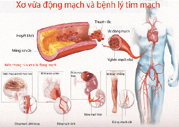 Các dấu hiệu nhận biết và điều trị bệnh xơ vữa động mạch