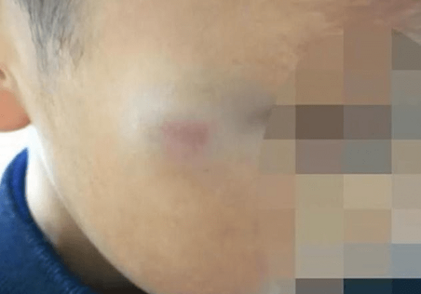 Bé 7 tuổi đi học bị đánh bầm tím, cô giáo bị đình chỉ nhưng khiến dân mạng tranh cãi