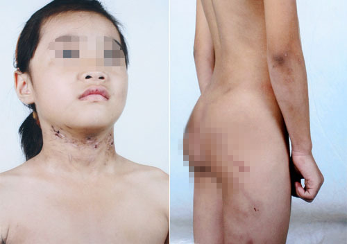 Xót thương bé gái 6 tuổi bị bố đẻ và dì ghẻ bạo hành dã man