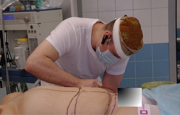 Kinh dị cảnh phẫu thuật rạch bụng, căng da, hút mỡ