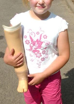 Bé gái 2 tuổi bị cắt cụt chân do y tá chẩn đoán sai bệnh