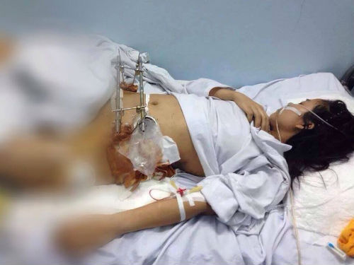 Thông tin mới vụ va chạm xe buýt, cô gái nguy kịch cần được giúp 