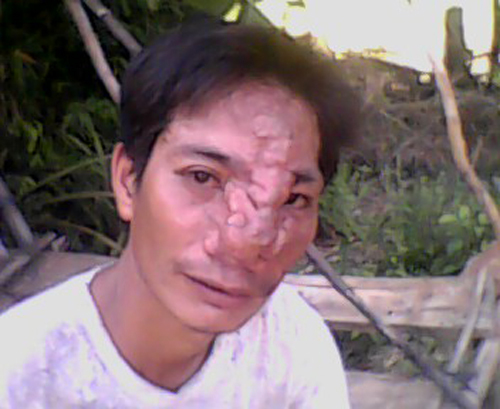 Chuyện đời bất hạnh của chàng trai có chiếc mũi 