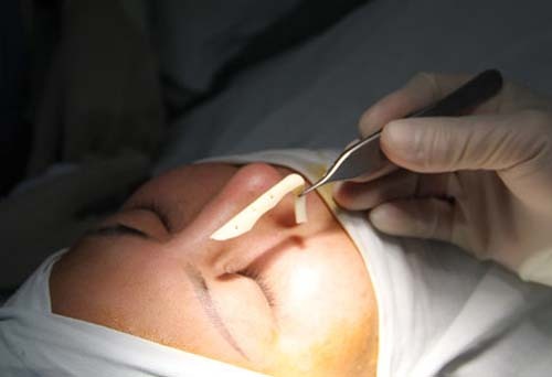 Nâng mũi bằng sụn tai: Có ngày “mất mặt” không còn... mũi!