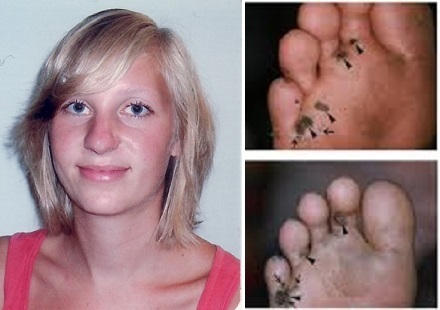  Kỳ lạ nữ nghiên cứu sinh nuôi bọ chét trong người suốt hai tháng