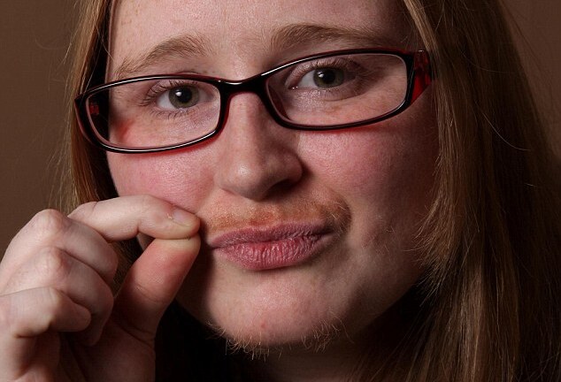 Kỳ lạ cô gái mọc râu như nam giới