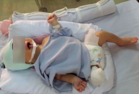 5 ngày giành giật sự sống của thai nhi văng khỏi bụng mẹ