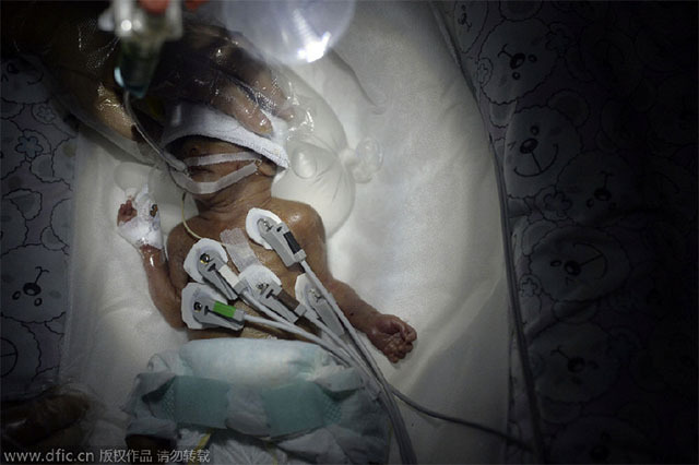 Sức sống thần kỳ của bé sơ sinh nặng 660g