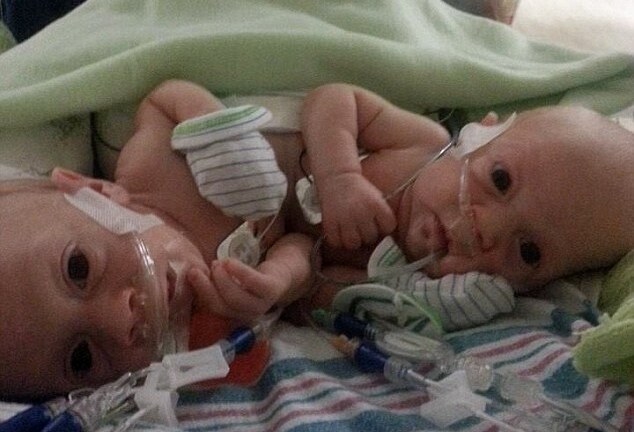 Phẫu thuật tách thành công cho cặp song sinh dính liền