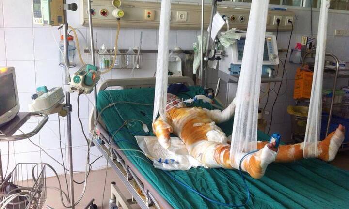 Ứa nước mắt cảnh cả nhà bỏng nặng do dùng xăng tẩy nhựa đường