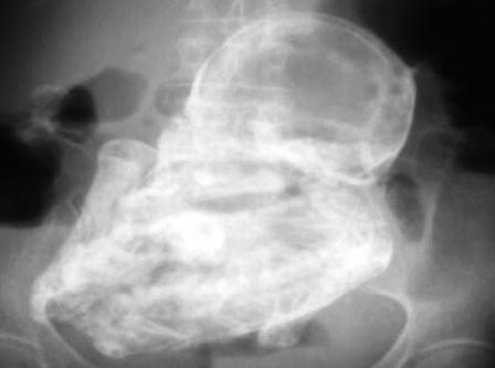 Kinh ngạc phát hiện bào thai 40 năm tuổi trong bụng cụ bà 82 