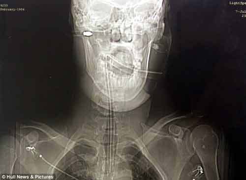 Thoát chết kỳ diệu sau khi bị mũi tên bắn xuyên đầu