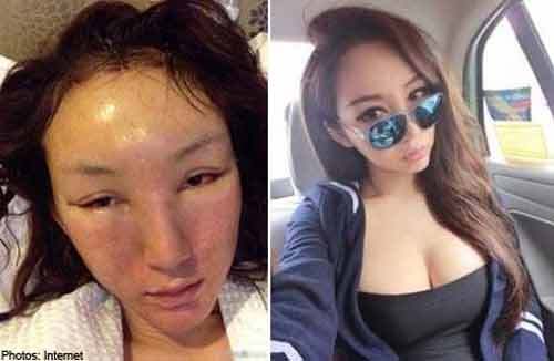 Phẫu thuật thẩm mỹ để tiến thân trong sự nghiệp người mẫu