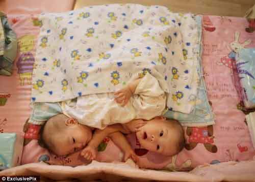 Thương tâm hai bé gái sinh đôi dính liền bị bỏ rơi