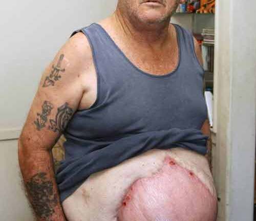 Kỳ lạ người đàn ông mang dạ dày to như quả bóng