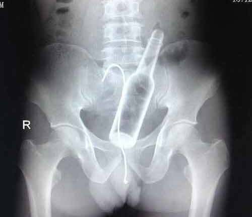 Nghịch dại, người đàn ông nhét cả chai, dây kim loại vào bụng 