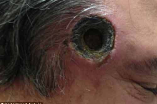 Thủng lỗ thái dương vì dùng thuốc lang băm