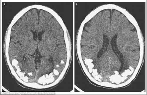 Chịu đau đầu suốt 10 năm vì não chứa sỏi can xi
