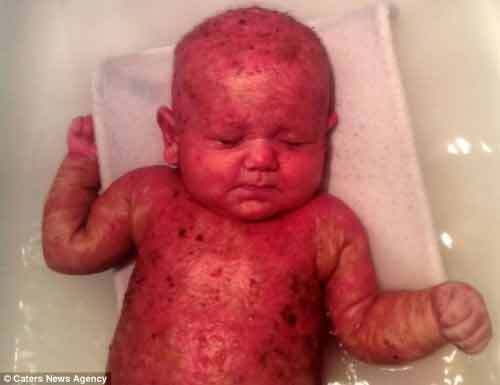 Thương cảm cậu bé mới sinh đã mắc chứng da bỏng rộp