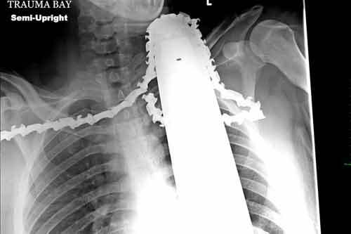 Kỳ diệu anh chàng sống sót dù bị lưỡi cưa găm vào cổ