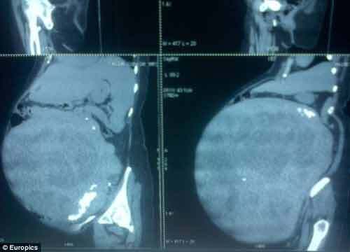 Cắt bỏ  khối u khổng lồ nặng 15,6 kg khỏi bụng của người phụ nữ