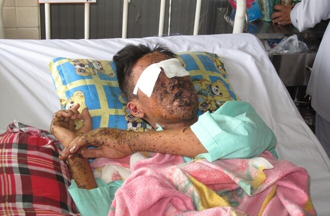 Lò bánh tét phát nổ, nam thanh niên vỡ nát hai mắt