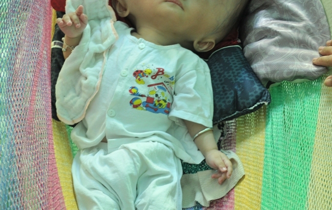 Khốn khổ cuộc sống của bé 14 tháng tuổi có đầu to gấp bốn lần cơ thể