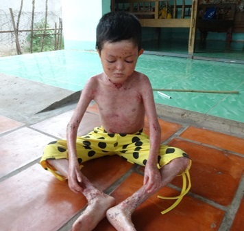 Xót xa bé 11 tuổi mắc bệnh 