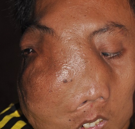Chàng trai đáng thương với ước mơ được cắt bỏ khối u khổng lồ trên mặt