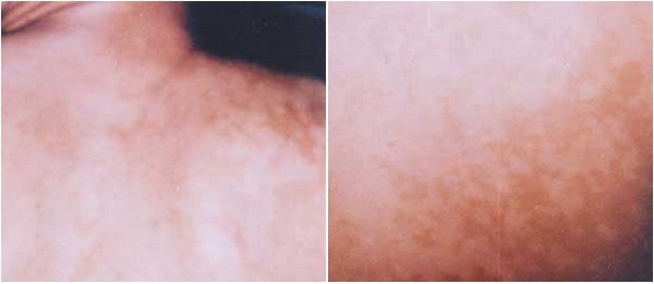 Chữa dứt điểm bệnh lang ben