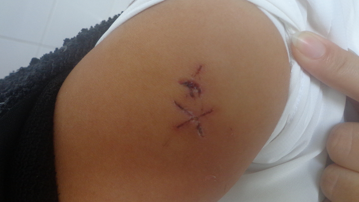 Sếp nữ dùng kéo đâm công nhân nhập viện