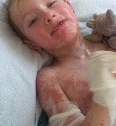 Hình ảnh đau lòng của em bé bị dị ứng thuốc