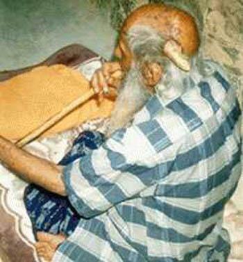 Cụ ông 102 tuổi bỗng nhiên mọc sừng trên đầu