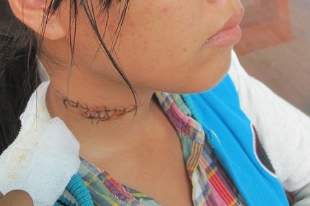 Chồng dùng dao cứa cổ vợ vì cuồng ghen