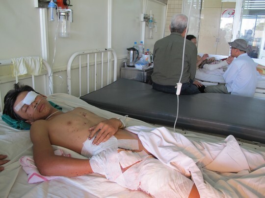 Thiếu niên bị thương nặng do nổ pin khi chế tạo đồ chơi Tết