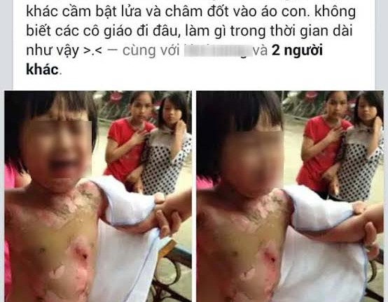 Bé gái 4 tuổi bị bỏng toàn thân: Tình hình sức khỏe hiện tại