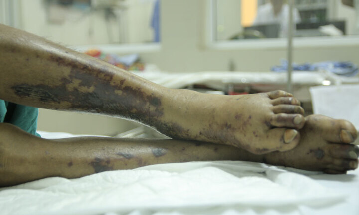 Những hình ảnh đáng sợ về bệnh liên cầu lợn do ăn tiết canh