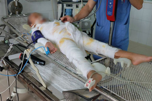 Bé gái bị ngã trong nồi cám lợn bỏng sâu 65\% đã qua đời