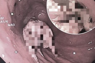 Người đàn ông suýt chết nghẹn vì nuốt chửng cả con bạch tuộc sống