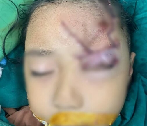Bé gái 5 tuổi tổn thương vùng mặt nghiêm trọng do bị chó cắn
