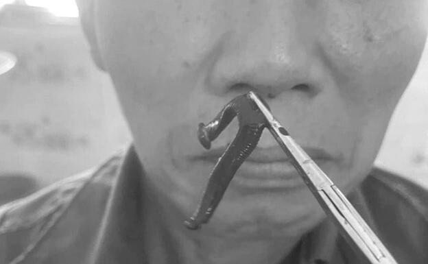 Người đàn ông bị đỉa sống làm tổ trong mũi suốt 2 tuần