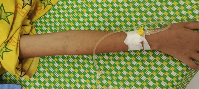 Bé gái 11 tuổi liên tục sốt cao, người nhà chữa mẹo bằng cách dùng dao lam