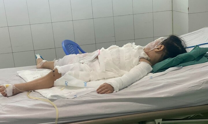 Bé 2 tuổi bị bỏng nặng do uống nhầm nước tẩy bồn cầu