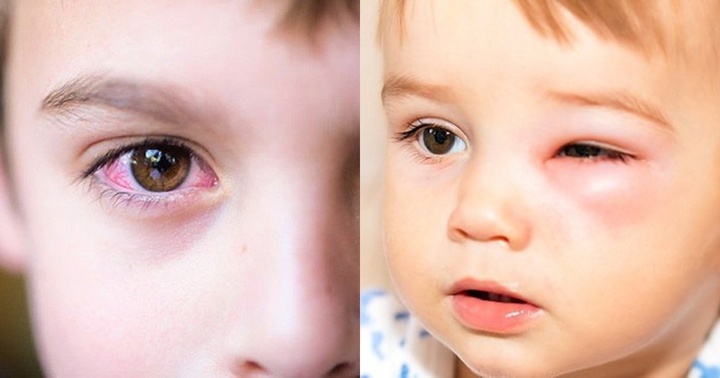 Bác sĩ cảnh báo dịch đau mắt đỏ lây lan nhanh, nhiều trẻ biến chứng nặng