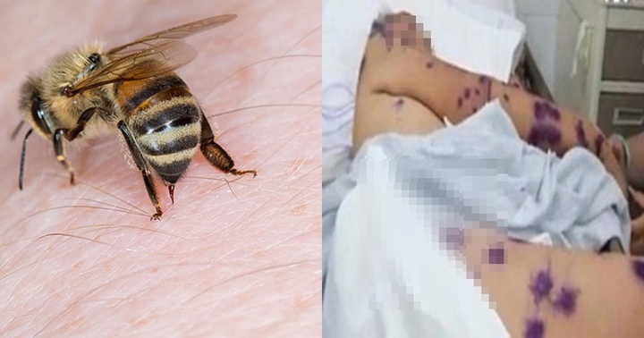 Cấp cứu hai bệnh nhân bị ong đốt hàng trăm nốt khắp cơ thể