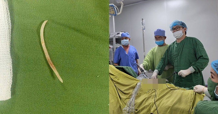 Người đàn ông bị áp xe gan do nuốt phải xương mà không biết