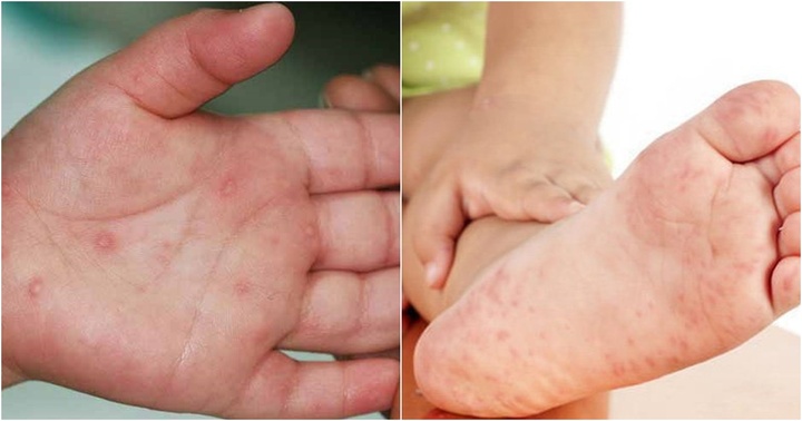 Bệnh nhi 3 tuổi tử vong sau 15 phút nhập viện do mắc tay chân miệng