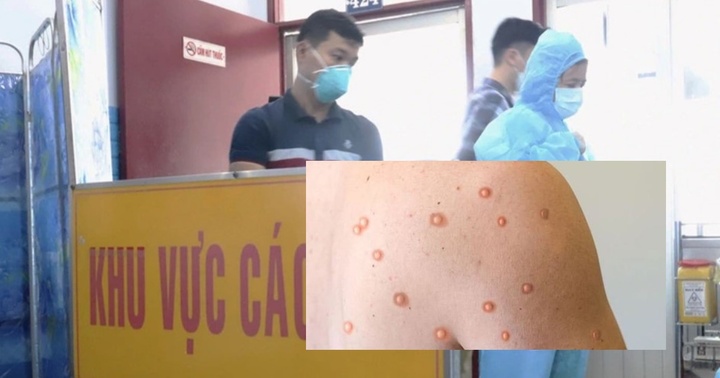 Đồng Nai: Ghi nhân thêm ca đậu mùa khỉ thứ hai