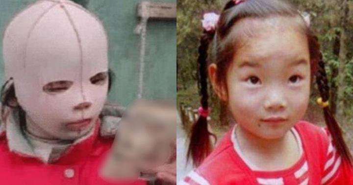 Bé gái 10 tuổi trùm mặt nạ đi học vì sợ bạn bè cười chê, câu chuyện phía sau khiến ai cũng bật khóc